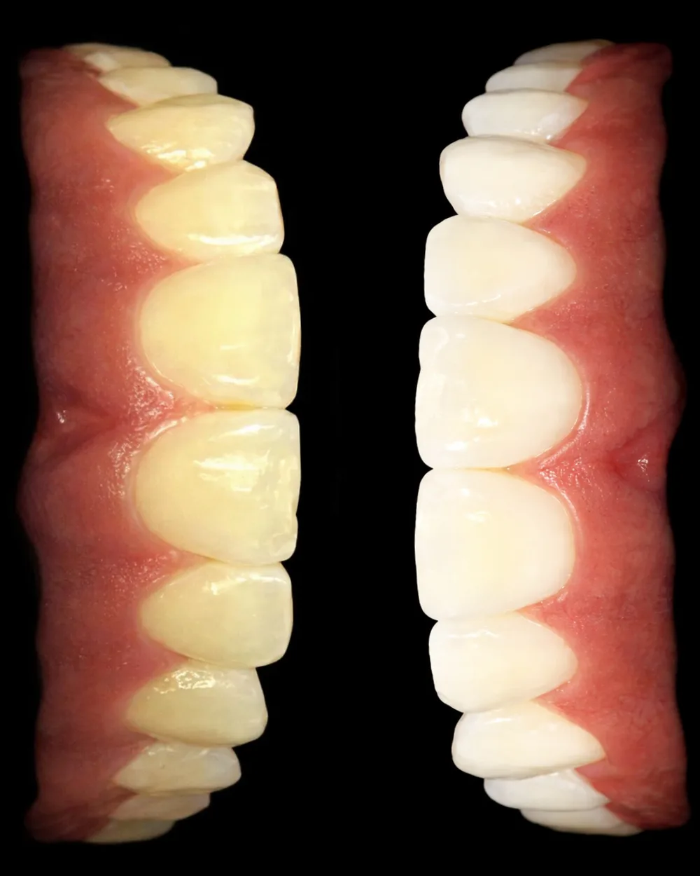 Antes e depois: clareamento dental