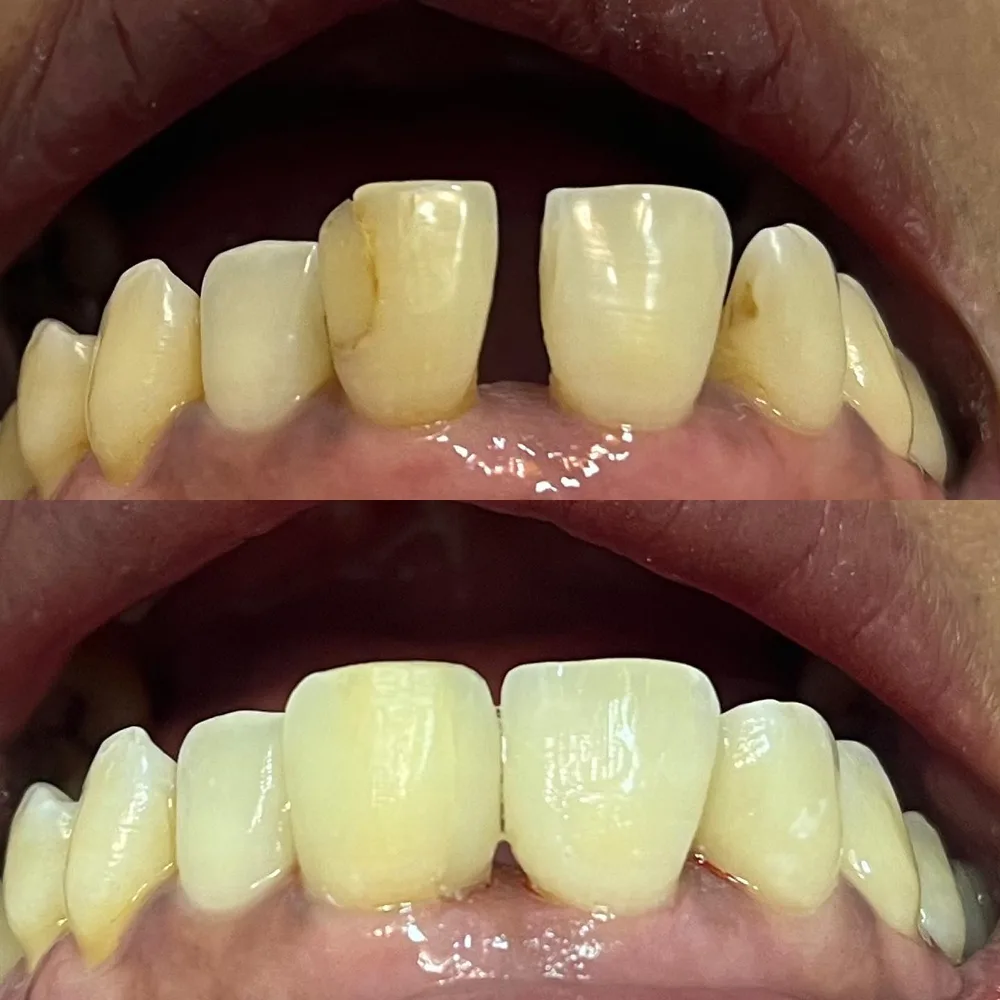 Antes e depois: fechamento de espaço com resina