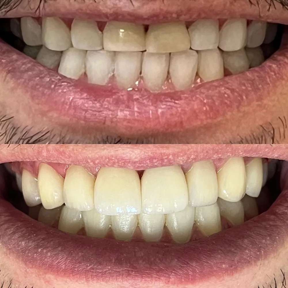 Antes e depois: lentes de contato em porcelana