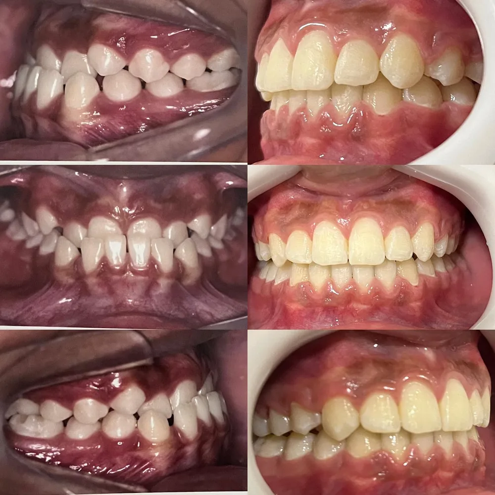 Antes e depois: tratamento ortodôntico