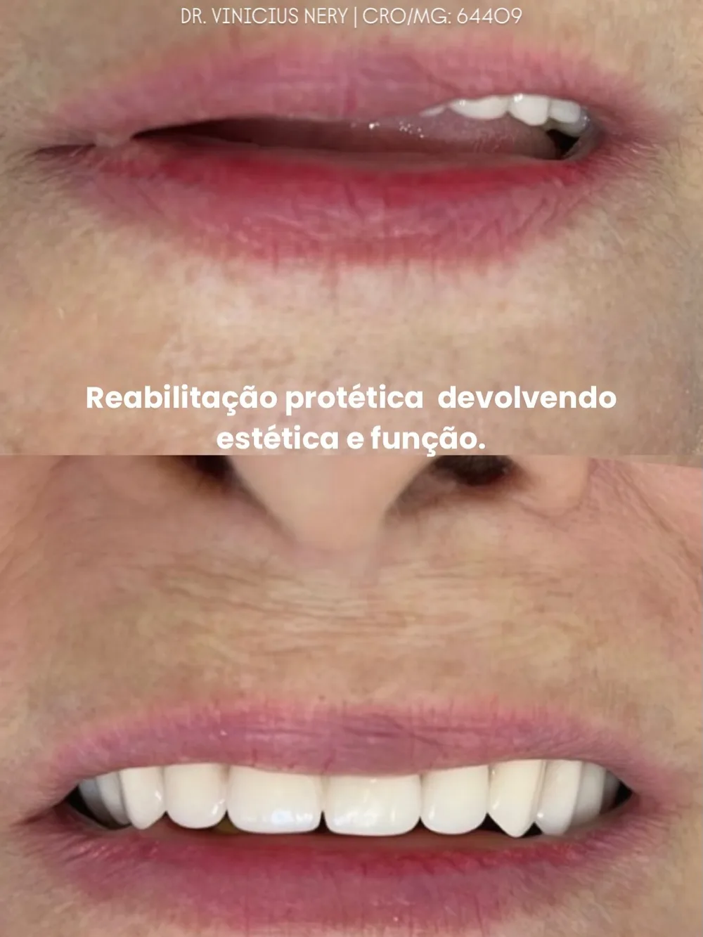 Antes e depois: reabilitação com prótese