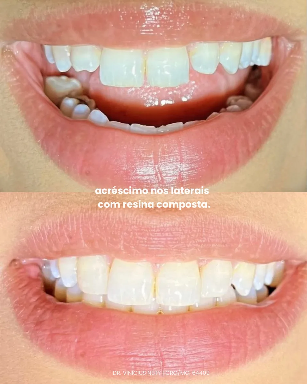 Antes e depois: acréscimo de resina nos dentes laterais